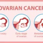 Understanding the Ovarian Cancer Symptoms: Importance of Early Awareness and Detection 8