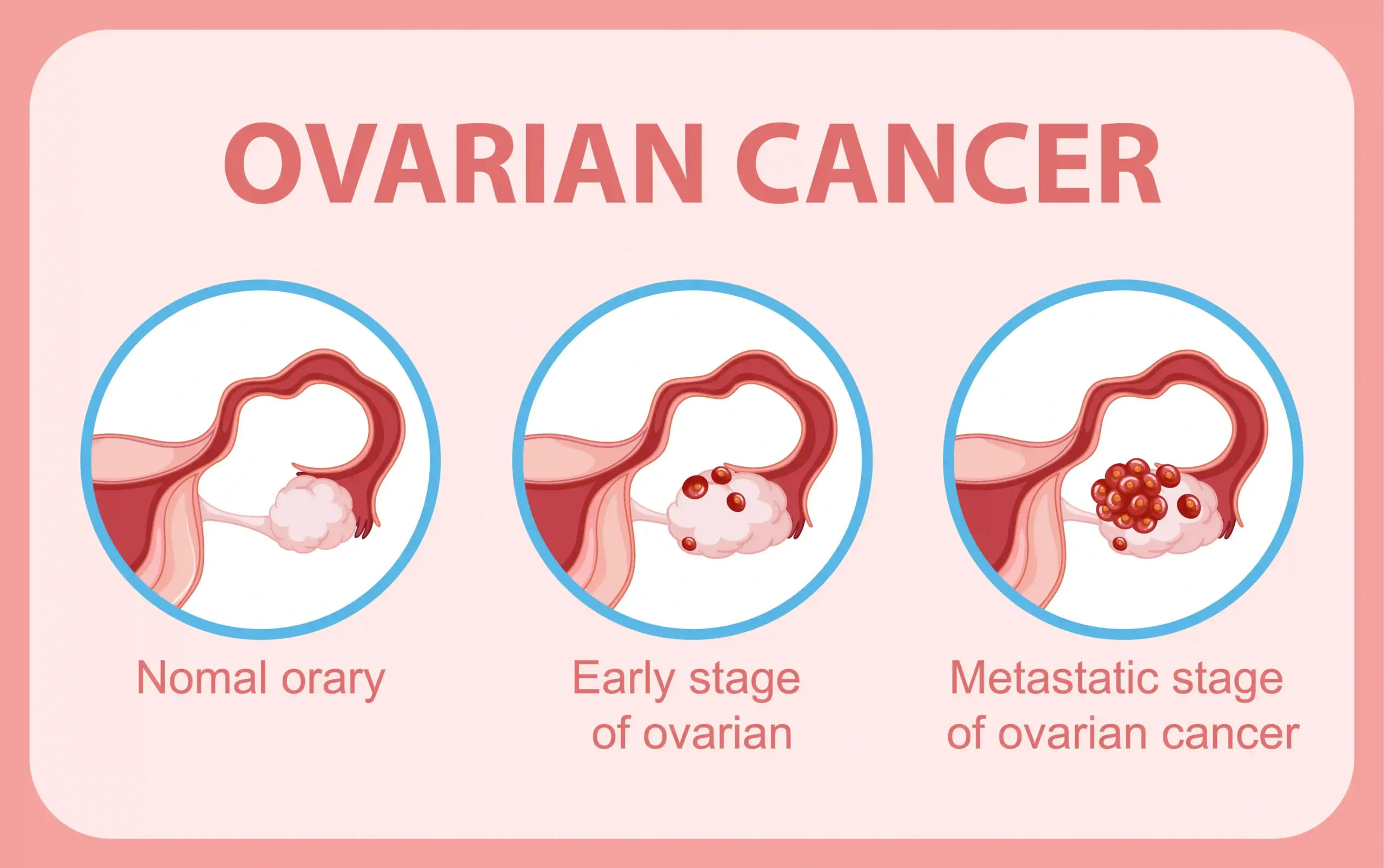 Understanding the Ovarian Cancer Symptoms: Importance of Early Awareness and Detection 8